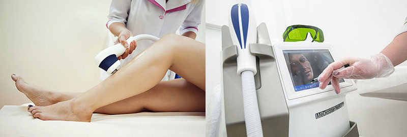 Лазер или фотоэпиляция